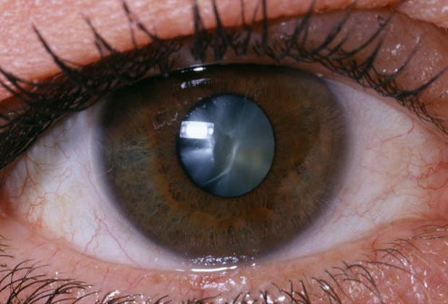 Учёные нашли безоперационный способ лечения катаракты