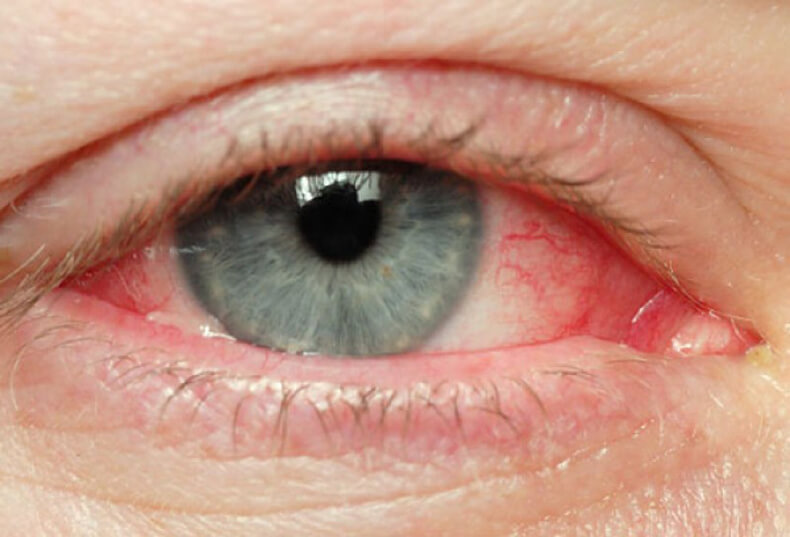 Глаукома: почему возникает и как предотвратить заболевание