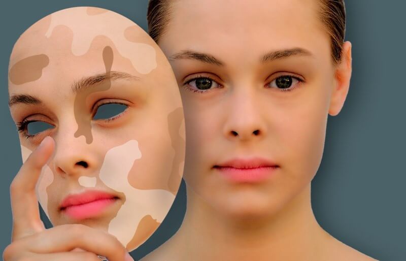 6 эффективных натуральных средств для избавления от пигментных пятен на коже