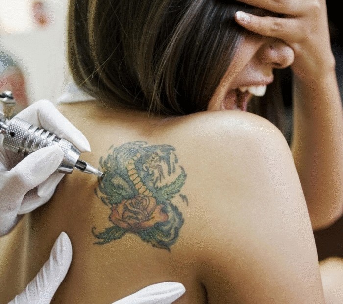 Удаление тату может вызвать рак кожи