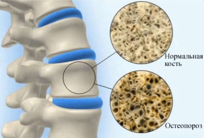 Эффективнейший бальзам при переломах, лечении остеопороза
